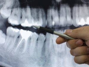 Komplette Zahnsanierung – Wichtige Infos und Tipps